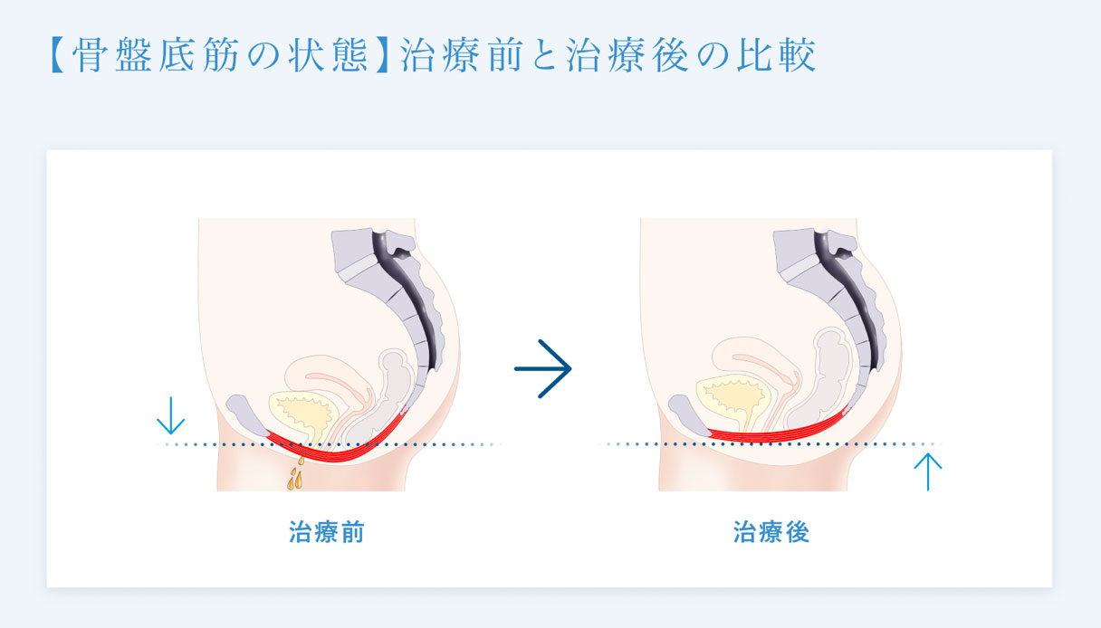 磁気刺激装置（エムセラ）